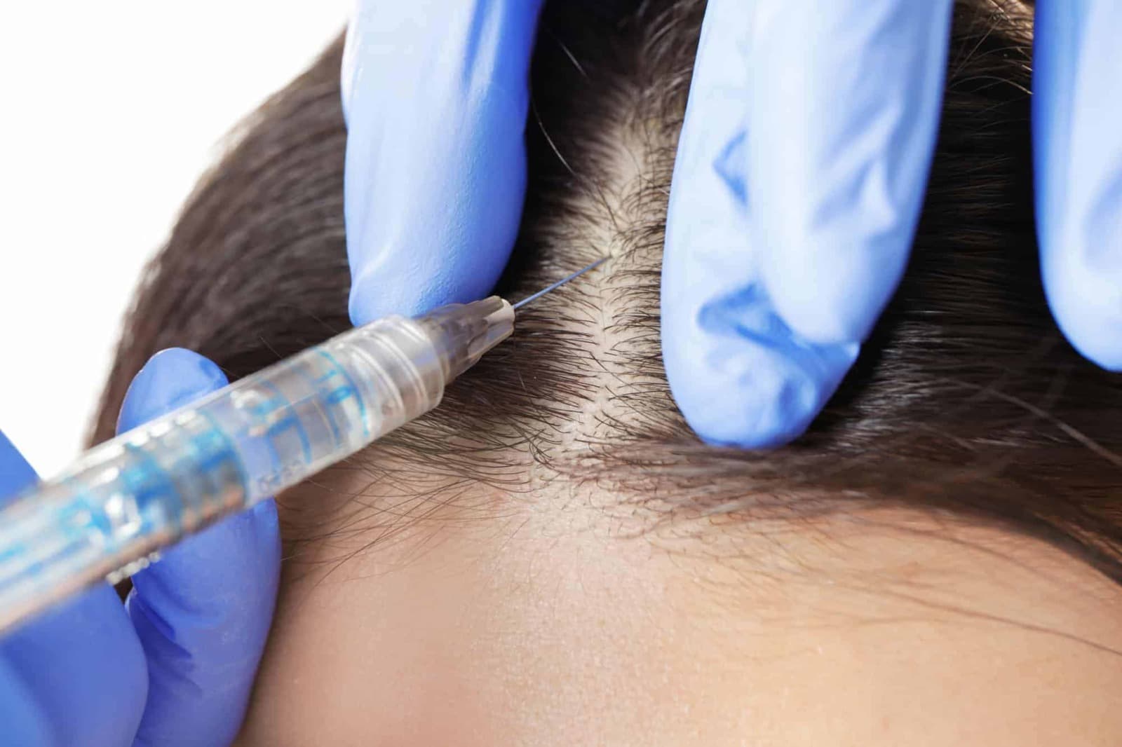 Hair Transplant – Expert Surgeons in the Heart of London