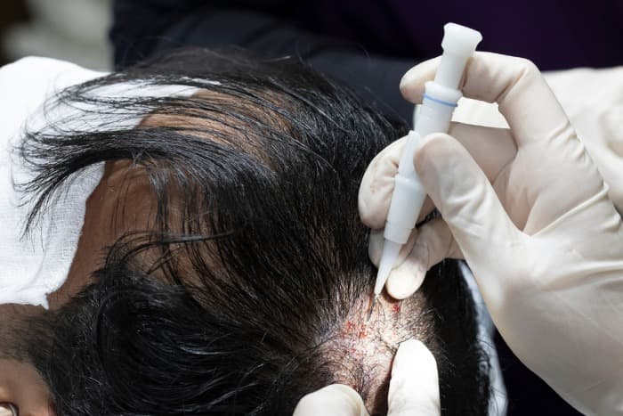 Hair Transplant Istanbul – Premium Service for Maximum Results