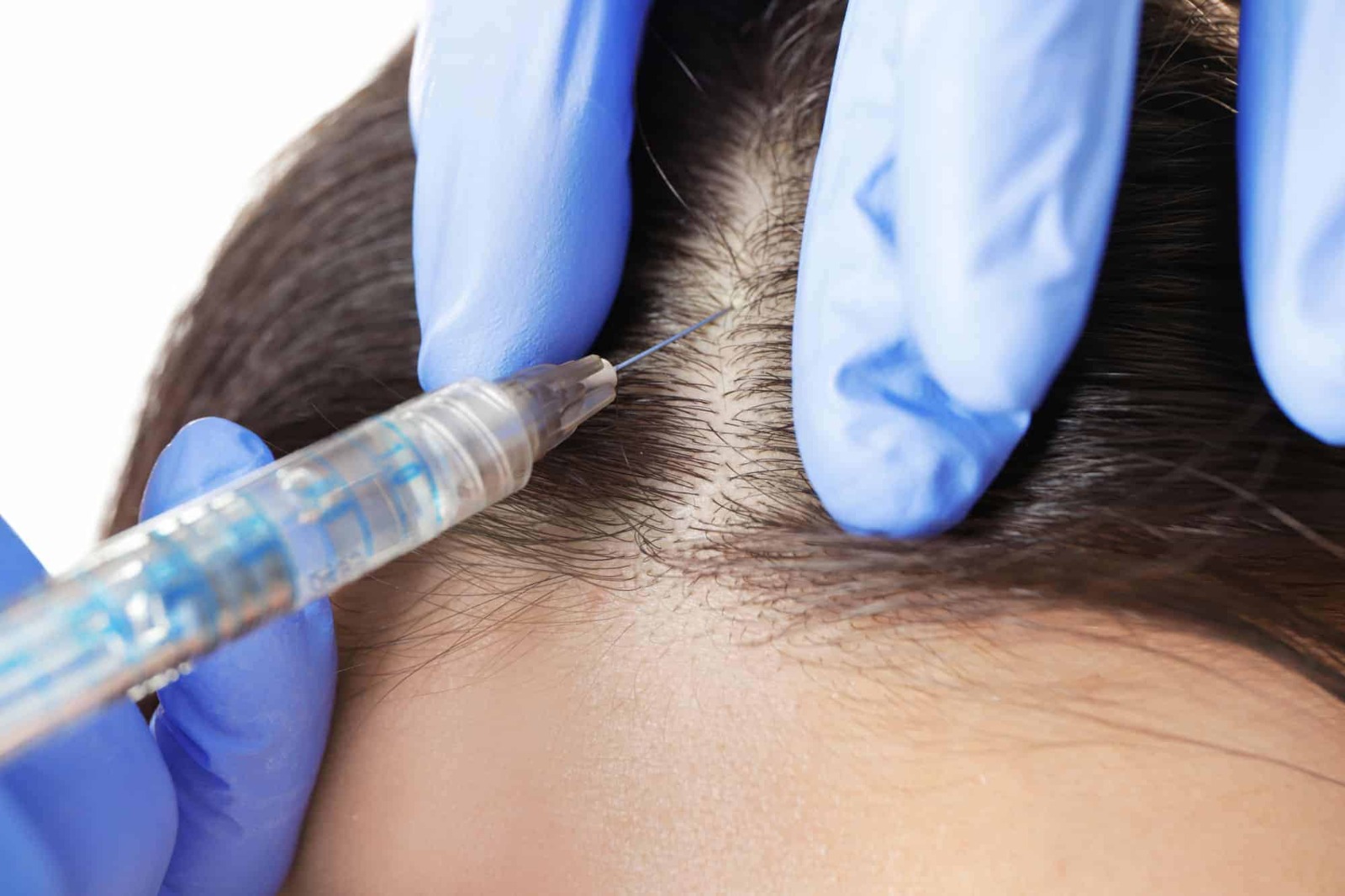 Hair Transplant – Expert Surgeons in the Heart of London