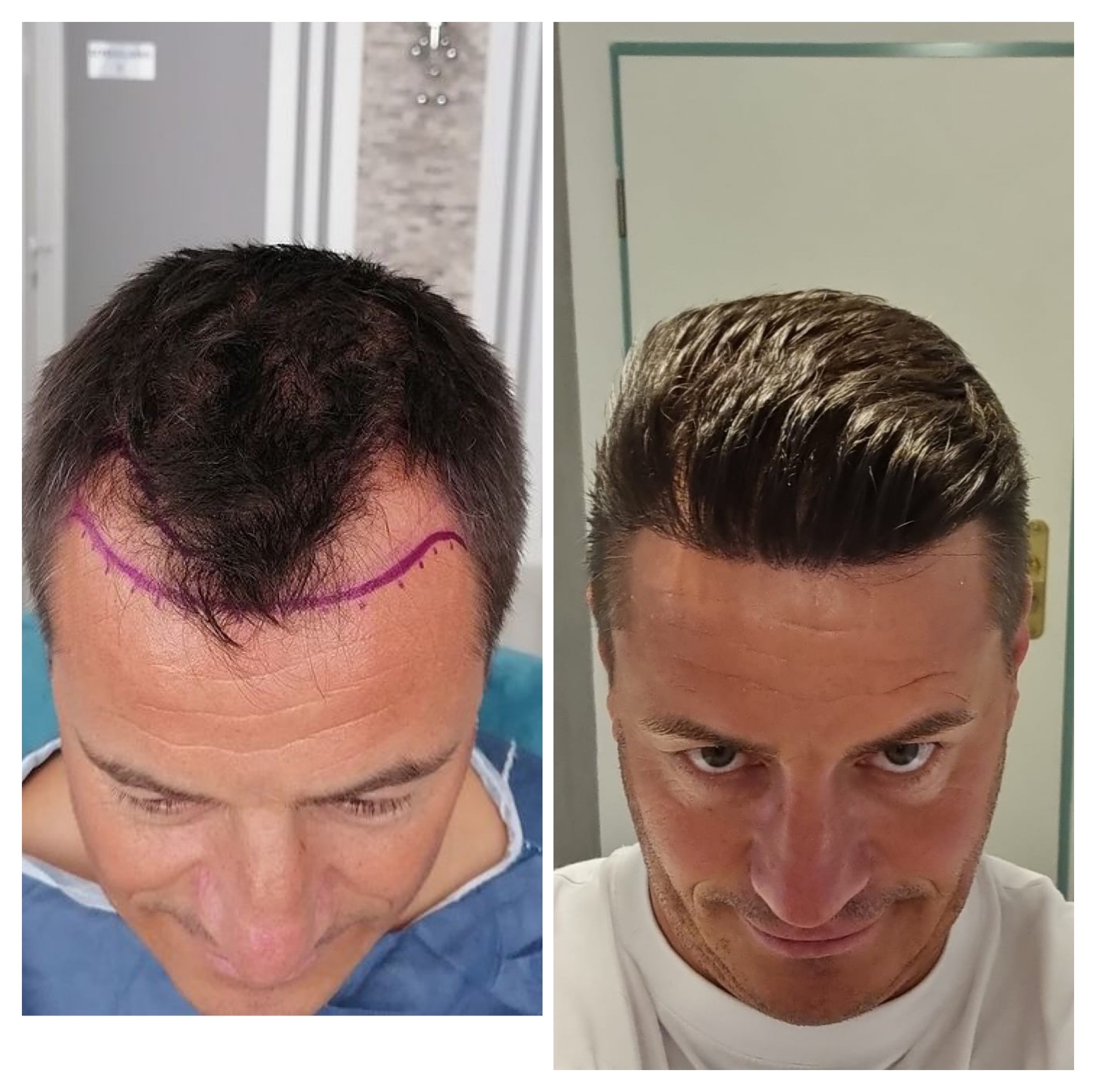 Hair Transplant UK – Trusted by Thousands of Satisfied Patients
